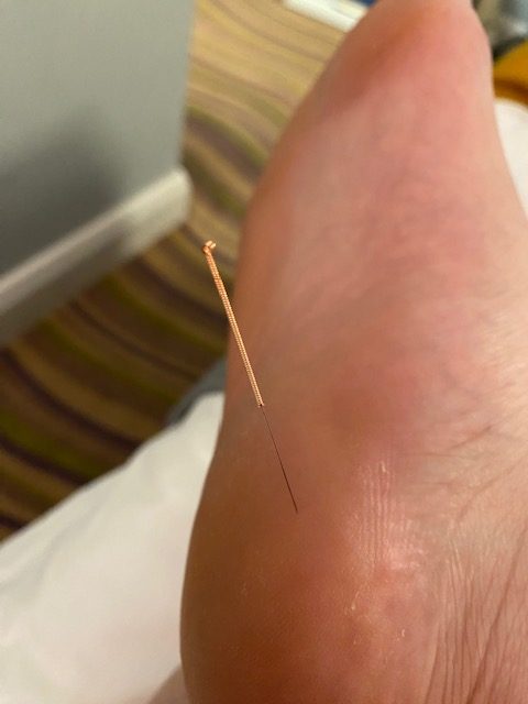 Acupuncture needle in my foot- it helped!